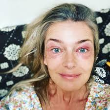 Exactly 40 years after my very first (german) vogue cover at the age of sixteen, here is a new one. Paulina Porizkova Shows Aftermath Of Skin Tightening Treatments People Com