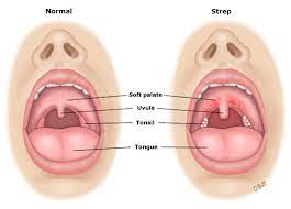 patient education sore throat in