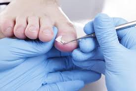 an ingrown toenail