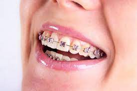 cuts in the mouth from braces how to