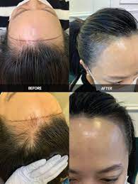 hairline embroidery semi permanent