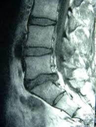 adolescent disc herniation