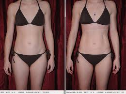 i lipo before and after