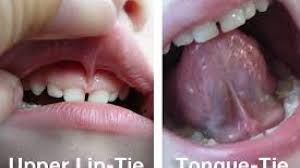 what does a tongue tie look like tmj