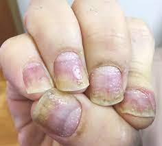 nail psoriasis causes symptoms