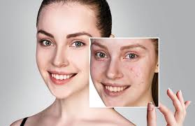 traitement de l acné dr fournier