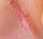 scar tissue