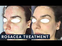 treating rosacea with ipl you