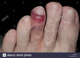 That alone wouldn't have warranted one star (i. What Does A Broken Pinky Toe Look Like Quora