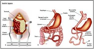 gastric byp procedure blood