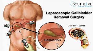 laparoscopic gallbladder removal signs