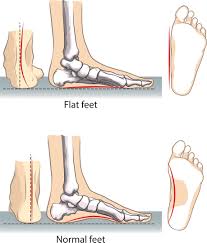 High heels and footwear without adequate metatarsal arch support can aggrevate the connective tissue area around the metatarsal bones causing pain in the ball of the foot (metatarsalgia). Flat Feet Pain Treatment Symptoms Advanced Foot Ankle