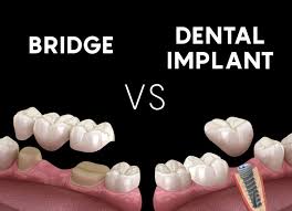 dental implant or bridge what is better