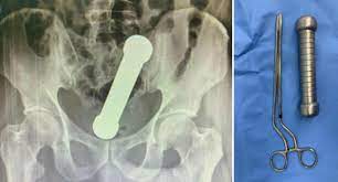 Bizarre 2kg find inside man's rectum