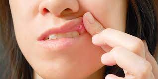 what causes canker sores in your mouth