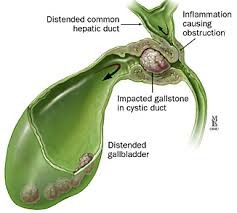 Gallstones Gastro Info