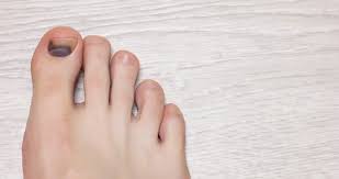 black toenails foot