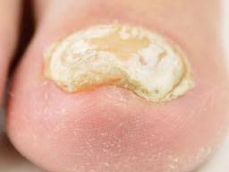 thick toenails causes symptoms and
