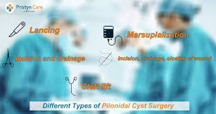 diffe types of pilonidal cyst surgery