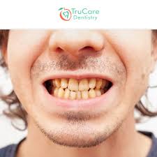calcium deposits on your teeth