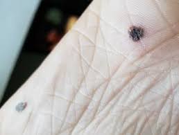 warts symptoms causes and removal tibot