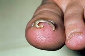 take care of ingrown toenails with foot