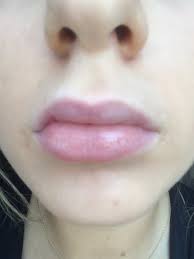 py lips after lip fillers 3 days ago