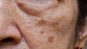 what are dark spots on skin and how can