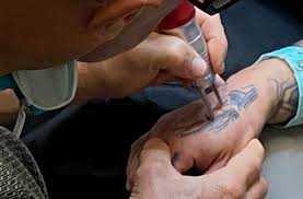offers tattoo removal