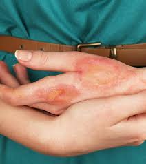 how to treat burns at home 13 natural