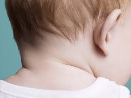 baby yeast infection on the neck
