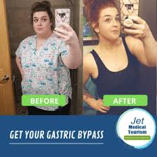 gastric byp before and after