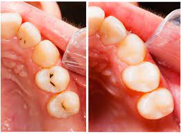 Salah satu penyebab sakit gigi setelah dicabut adalah alveolar osteitis atau dry socket. 14 Cara Menghilangkan Sakit Gigi Tanpa Ubat Cubalah