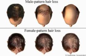 From weeks 13 to 24 each enrolled patient continued only with the treatment (both on the right and left site) that was judged to have a greater efficacy than that on the. Hair Loss In Men And Women Diagnosis And Treatment Options Carefirst Specialty Pharmacy S Blog