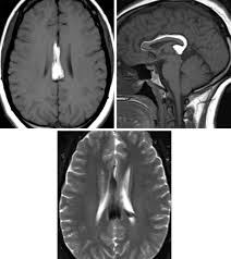 intracranial lipoma the neurosurgical