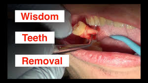 pediatric wisdom teeth removal guide