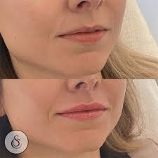 lipfiller 0 5ml before after