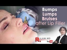 bruising after lip fillers dr rajani