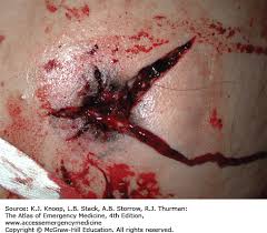 Stopping power is related to the physical properties and terminal behavior of the projectile (bullet, shots or slug), the biology of the target, and the wound . Clinical Forensic Medicine Anesthesia Key