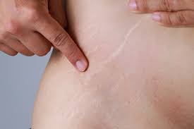 best tips on how to hide stretch marks