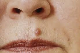 moles warts and other skin growths