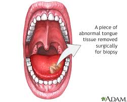 tongue biopsy information mount sinai