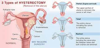 gynecological surgery mark j at