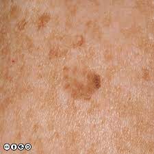 Malignant neoplasms of the skin are diverse. Mimics Of Skin Cancer I Skin Cancer 909