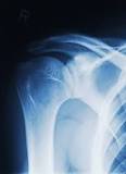 Image result for icd 10 code for dislocation of left shoulder joint