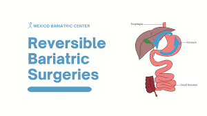reversible bariatric procedures