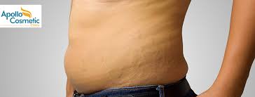 stretch marks removal home remes