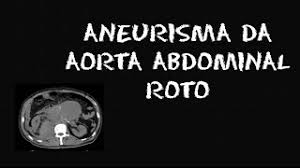 Un aneurisma cerebral es una enfermedad cerebrovascular que puede provocar hemorragia en el cerebro. Aneurisma Da Aorta Abdominal Roto Youtube