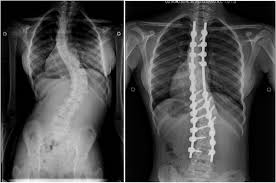 Scoliosis Treated At The Illinois Spine Scoliosis Center