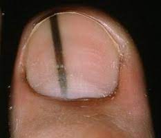 treatment options for melanoma in toenail
